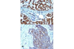 Immunohistochemical staining (Formalin-fixed paraffin-embedded sections) of (A) human hepatocellular carcinoma and (B) human ovarian carcinoma with RBP1 monoclonal antibody, clone RBP/872 . (RBP1 antibody)