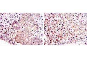 Immunohistochemical analysis of paraffin-embedded ovarian cancer (left) and kidney cancer (right) using MAP2K6 mouse mAb with DAB staining. (MAP2K6 antibody)