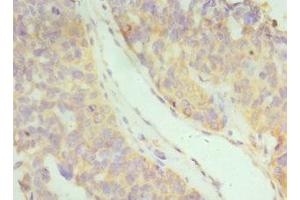 Immunohistochemistry of paraffin-embedded human endometrial cancer using ABIN7156580 at dilution of 1:100 (IFNAR2 antibody  (AA 27-243))