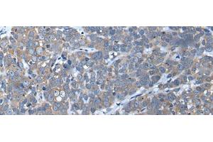 Immunohistochemistry of paraffin-embedded Human thyroid cancer tissue using UBAC2 Polyclonal Antibody at dilution of 1:50(x200) (UBAC2 antibody)
