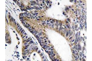 Immunohistochemical analysis of paraffin-embedded human colon cancer tissue using IQCB1 polyclonal antibody .