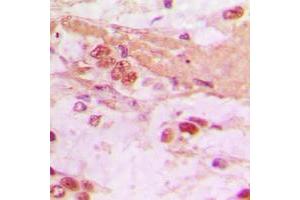 Immunohistochemical analysis of TSC22 staining in human lung cancer formalin fixed paraffin embedded tissue section. (TSC22D1 antibody  (C-Term))