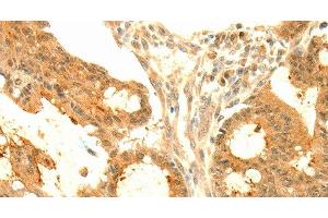 Immunohistochemistry of paraffin-embedded Human colon cancer tissue using SOCS6 Polyclonal Antibody at dilution 1:50 (SOCS6 antibody)