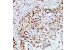 Immunohistochemistry of paraffin-embedded human mammary cancer using IGHMBP2 antibody (ABIN7267848) at dilution of 1:100 (40x lens). (IGHMBP2 antibody  (AA 540-720))