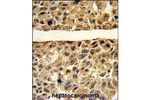Formalin-fixed and paraffin-embedded human hepatocarcinoma reacted with ARG1 Antibody , which was peroxidase-conjugated to the secondary antibody, followed by DAB staining. (Liver Arginase antibody  (C-Term))