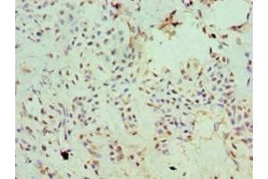 Immunohistochemistry of paraffin-embedded human breast cancer using ABIN7170006 at dilution of 1:100 (SLC2A2 antibody  (AA 235-485))
