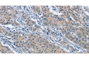 Immunohistochemistry of paraffin-embedded Human gastric cancer using KLF7 Polyclonal Antibody at dilution of 1:60 (KLF7 antibody)