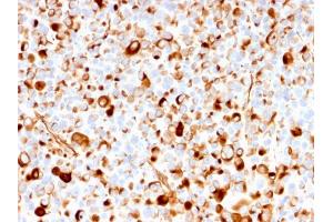 Formalin-fixed, paraffin-embedded human Melanoma stained with NGFR Mouse Recombinant Monoclonal Antibody (rNGFR/1965). (Recombinant NGFR antibody  (AA 281-421))