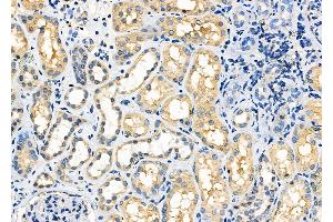 ABIN6265465 and ABIN6272777 at 1/100 staining Human kidney cancer and adjacent normal tissues by IHC-P.