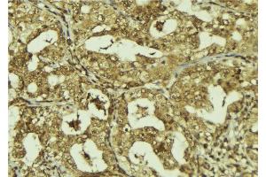 ABIN6273244 at 1/100 staining Human breast cancer tissue by IHC-P.