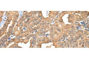 Immunohistochemistry of paraffin-embedded Human thyroid cancer tissue using C1GALT1C1 Polyclonal Antibody at dilution of 1:45(x200) (C1GALT1C1 antibody)