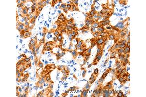 Immunohistochemistry of Human cervical cancer using SLC2A11 Polyclonal Antibody at dilution of 1:140 (SLC2A11 antibody)