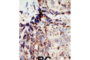Formalin-fixed and paraffin-embedded human cancer tissue reacted with the primary antibody, which was peroxidase-conjugated to the secondary antibody, followed by DAB staining. (BAP1 antibody  (N-Term))