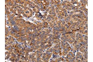 The image on the left is immunohistochemistry of paraffin-embedded Human thyroid cancer tissue using ABIN7130361(NDUFA1 Antibody) at dilution 1/70, on the right is treated with fusion protein. (NDUFA1 antibody)