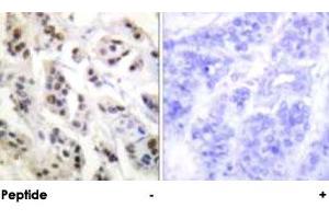Immunohistochemical analysis of paraffin-embedded human breast carcinoma tissue using LMNA polyclonal antibody . (Lamin A/C antibody)