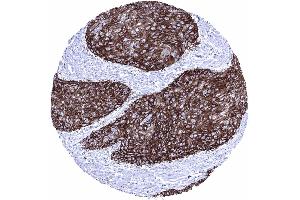 Skin Squamous cell carcinoma showing a strong GLUT1 immunostaining of tumor cells (Recombinant GLUT1 antibody  (AA 203-305))