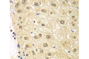 Immunohistochemistry of paraffin-embedded Human liver damage using PSMD2 Polyclonal Antibody at dilution of 1:100 (40x lens).