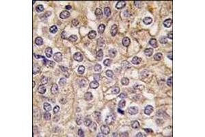 Formalin-fixed and paraffin-embedded human prostata carcinoma tissue reacted with IL1R antibody (C-term), which was peroxidase-conjugated to the secondary antibody, followed by DAB staining. (IL1RL2 antibody  (C-Term))