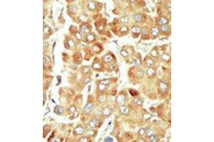 Formalin-fixed and paraffin-embedded human cancer tissue reacted with the primary antibody, which was peroxidase-conjugated to the secondary antibody, followed by DAB staining. (SRPK1 antibody  (N-Term))