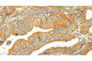 Immunohistochemistry of paraffin-embedded Human colon cancer tissue using GK1 Polyclonal Antibody at dilution 1:60 (Glycerol Kinase antibody)