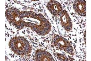 IHC-P Image Immunohistochemical analysis of paraffin-embedded human colon carcinoma, using MEK2, antibody at 1:500 dilution. (MEK2 antibody)
