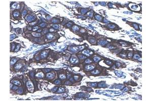 Immunohistochemical staining for c-erbB-2. (ErbB2/Her2 antibody  (AA 1242-1255))