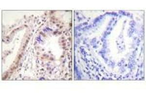 Immunohistochemistry analysis of paraffin-embedded human lung carcinoma tissue using Estrogen Receptor-α (Ab-537) antibody. (Estrogen Receptor alpha antibody  (Tyr537))
