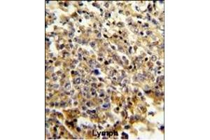 Formalin-fixed and paraffin-embedded human lymphoma reacted with NCF4 Antibody (C-term), which was peroxidase-conjugated to the secondary antibody, followed by DAB staining. (NCF4 antibody  (C-Term))