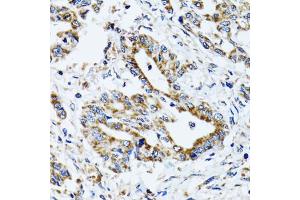 Immunohistochemistry of paraffin-embedded human colon carcinoma using ATP5B antibody. (ATP5B antibody)