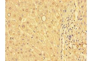 Immunohistochemistry of paraffin-embedded human liver tissue using ABIN7154103 at dilution of 1:100 (GSTM1 antibody  (AA 24-156))