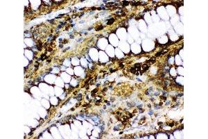 IHC-P: p73 antibody testing of human intestinal cancer tissue (Tumor Protein p73 antibody  (AA 1-198))
