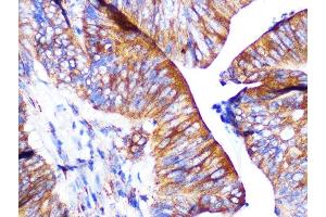Immunohistochemistry of paraffin-embedded human colon carcinoma using P Rabbit mAb (ABIN1683023, ABIN7101760, ABIN7101761 and ABIN7101762) at dilution of 1:100 (40x lens). (F2RL1 antibody)