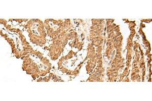Immunohistochemistry of paraffin-embedded Human thyroid cancer tissue using VPS50 Polyclonal Antibody at dilution of 1:45(x200) (Syndetin/VPS50 antibody)