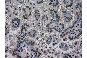 Immunohistochemical staining of paraffin-embedded Carcinoma of kidney tissue using anti-NRBP1mouse monoclonal antibody. (NRBP1 antibody)