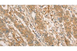 Immunohistochemistry of paraffin-embedded Human gastric cancer using CPB1 Polyclonal Antibody at dilution of 1:60 (CPB1 antibody)