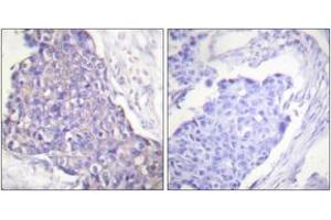 Immunohistochemistry analysis of paraffin-embedded human breast carcinoma tissue, using CD40 Antibody.