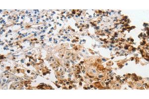 Immunohistochemistry of paraffin-embedded Human cervical cancer using LCN2 Polyclonal Antibody at dilution of 1:60 (Lipocalin 2 antibody)