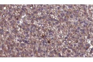ABIN6276846 at 1/100 staining Human liver cancer tissue by IHC-P. (GABRG2 antibody  (N-Term))
