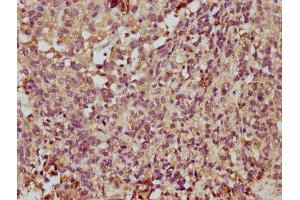 IHC image of ABIN7173067 diluted at 1:350 and staining in paraffin-embedded human ovarian cancer performed on a Leica BondTM system. (TMEM14A antibody  (AA 45-78))