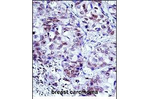 HIST1H1D Antibody (Center) (ABIN657667 and ABIN2846660) immunohistochemistry analysis in formalin fixed and paraffin embedded human breast carcinoma followed by peroxidase conjugation of the secondary antibody and DAB staining. (Histone H1.3 antibody  (AA 135-164))