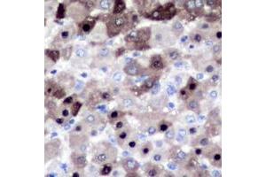 Immunohistochemical analysis of XPO2 staining in human liver cancer formalin fixed paraffin embedded tissue section. (Exportin 2 antibody  (N-Term))