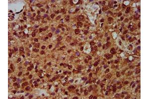 IHC image of ABIN7170618 diluted at 1:200 and staining in paraffin-embedded human glioma performed on a Leica BondTM system. (SF3B1 antibody  (AA 186-378))
