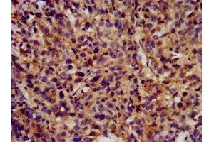 IHC image of ABIN7163969 diluted at 1:300 and staining in paraffin-embedded human ovarian cancer performed on a Leica BondTM system.