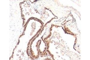 Formalin-fixed, paraffin-embedded human prostate cancer stained with p27Kip1 antibody (KIP1/769) (CDKN1B antibody)