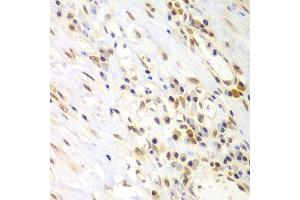 Immunohistochemistry of paraffin-embedded human gastric cancer using LHX4 antibody at dilution of 1:100 (x400 lens). (LHX4 antibody)