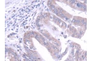Detection of FGF20 in Human Liver cancer Tissue using Polyclonal Antibody to Fibroblast Growth Factor 20 (FGF20) (FGF20 antibody  (AA 1-211))
