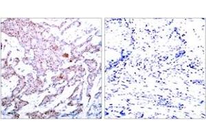 Immunohistochemistry analysis of paraffin-embedded human breast carcinoma, using NF-kappaB p65 (Phospho-Ser536) Antibody. (NF-kB p65 antibody  (pSer536))