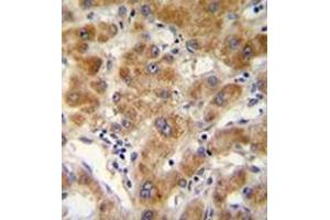 Immunohistochemistry analysis in formalin fixed and paraffin embedded human hepatocarcinoma reacted with ODF3B Antibody (N-term) followed by peroxidase conjugation of the secondary antibody and DAB staining. (ODF3B antibody  (N-Term))