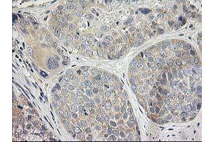 Immunohistochemical staining of paraffin-embedded Adenocarcinoma of Human breast tissue using anti-ITFG2 mouse monoclonal antibody. (ITFG2 antibody)