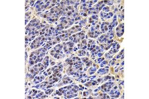 Immunohistochemistry of paraffin-embedded human liver cancer using HIRIP3 antibody at dilution of 1:100 (x400 lens). (HIRIP3 antibody)